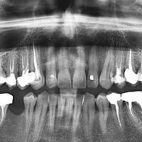 digital dental x-ray