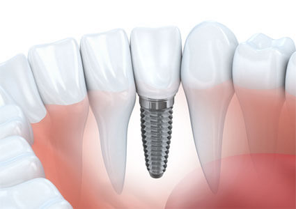 3D illustration of a dental implant