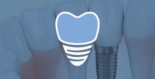 dental implant illustration